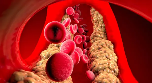 Czerwone krwinki przepływające przez zatkane cholesterolem naczynie krwionośne.